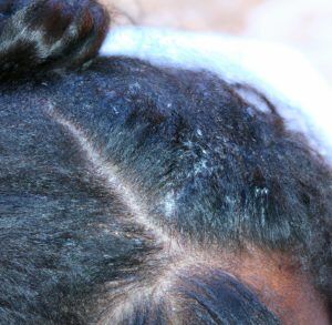 cheveux-afro-pellicules